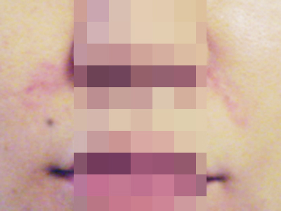ヒアルロン